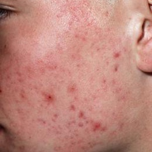 Mild inflammatorisk akne