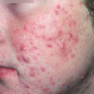 Medelsvår inflammatorisk akne