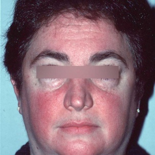 Erytematoteleangiektatisk rosacea (ETR)