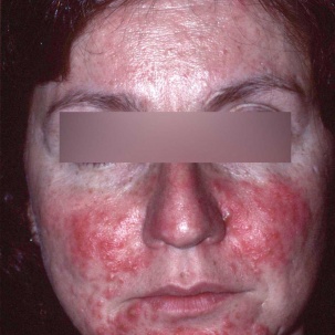 Svår papulopustulös rosacea (PPR)