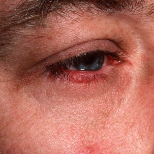 Ögonrosacea